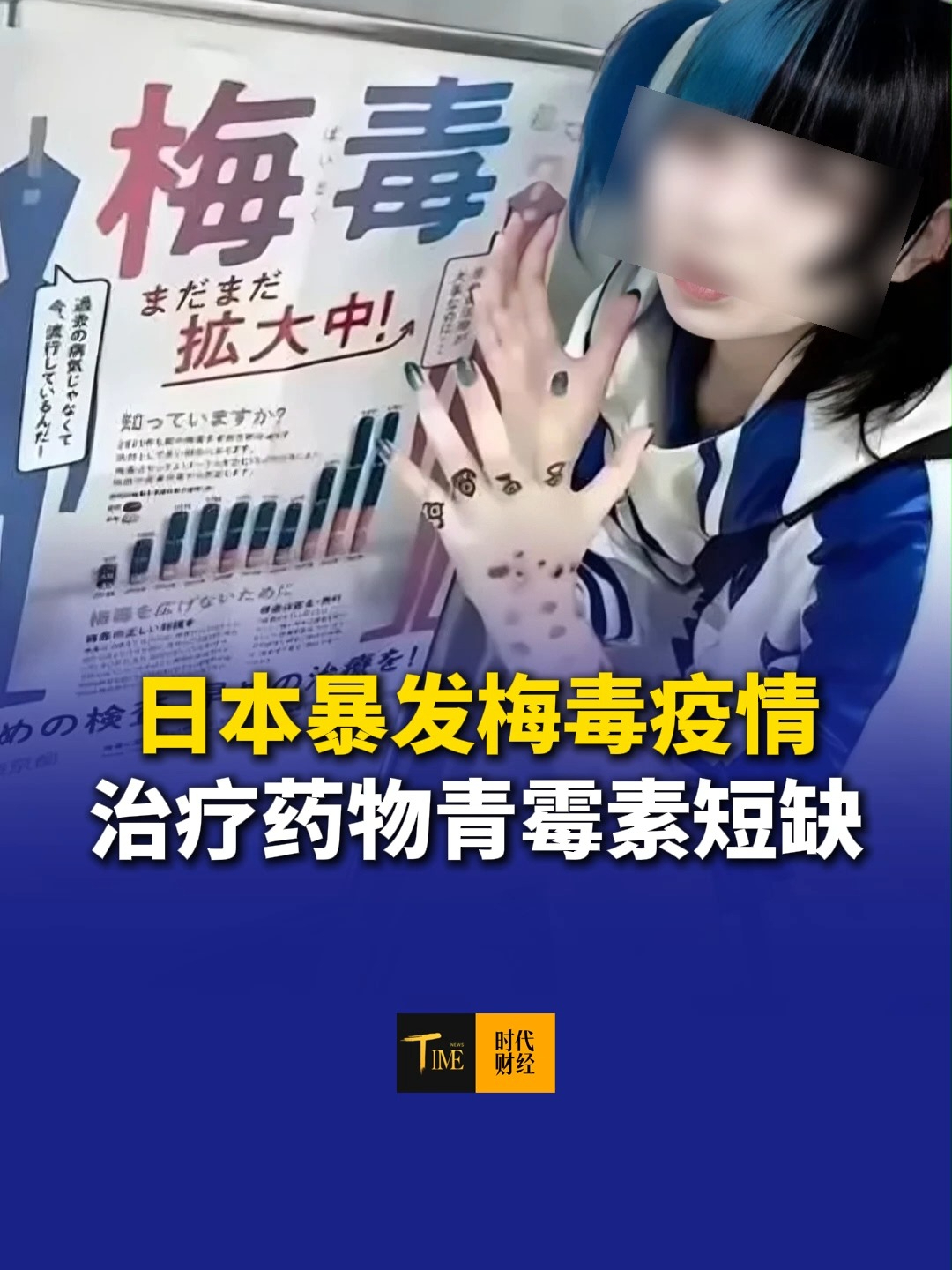日本暴发梅毒疫情，治疗药物青霉素短缺，感染者男性占约三分之二。专家认为，社交媒体、交友软件的无序发展导致与不特定多人的性行为增加。